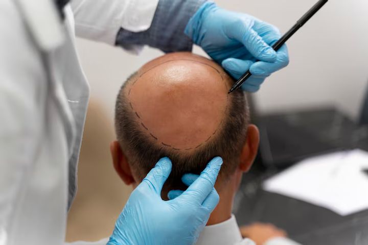 Hair Transplant Explained: Discover Facts, Learn Basics, and Helpful Resources